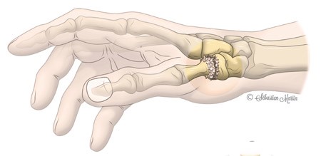 Schéma de la rhizarthrose -pincement articulaire et ostéophytes trapèzométacarpiens