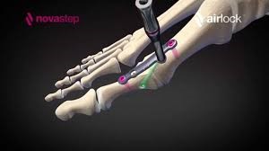 novastep_airlock