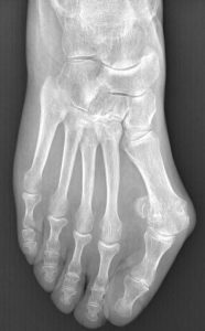 Hallux valgus. Dr Yohann Fournier chirurgien orthopédiste Rennes Hallux Valgus sur patiente de 70 ans, avant opération. l'hallux valgus atteint 40°. Photo Dr Yohann Fournier, chirurgien orthopédiste Rennes/Cesson-Sévigné.