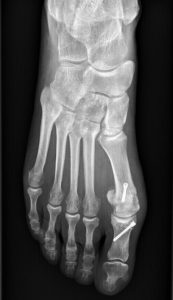 Hallux valgus opéré par le Dr Fournier, chirurgien orthopédiste Rennes/Cesson-Sévigné. Hallux valgus opéré par le Dr Fournier, chirurgien orthopédiste Rennes/Cesson-Sévigné.