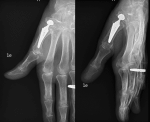 Prothèse de pouce, traitement de la rizarthrose. (Dr Margaux Bebing, Rennes)